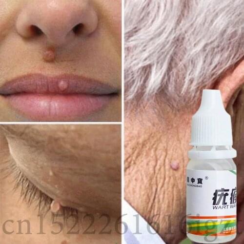 Foot Corn Treatment Skin Tag Warts Removal Plantar Warts Pomada De Verruga Foot Care Medical Plaster Ointment 10ml