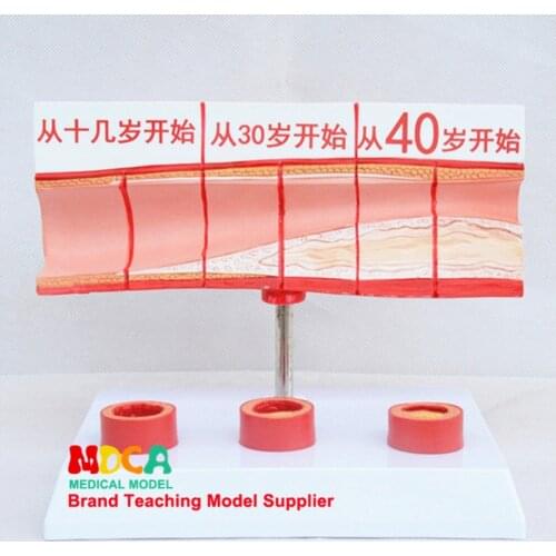 Blood Concentration of Vascular Blockage, Fatty Physiology, Vascular Pathology and Anatomy Model Medical Teaching MXG006