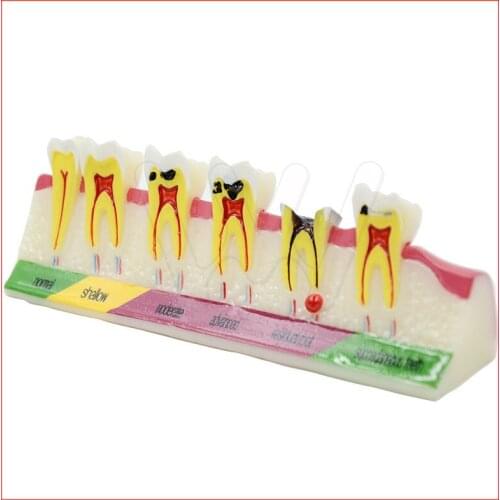 Dental Caries Developing illusteation Tooth Model Demonstration Teach Patient
