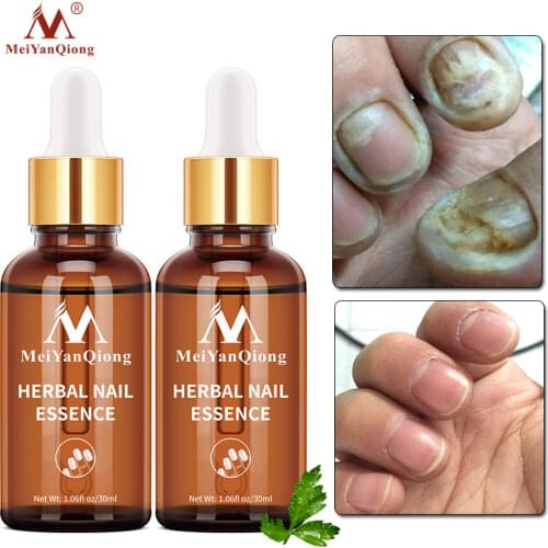 2pcs/lot Fungal Nail Treatment Repair Essence Nail and Foot Hand Care Whitening Toe Nail Anti Fungus Removal Infection Nail Gel