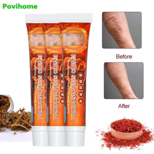 3pcs Varicose Veins Treatment Cream Varicosity Angiitis Remedy Ointment Vascular Inflammation Varicose Vein Pain Relief Ointment