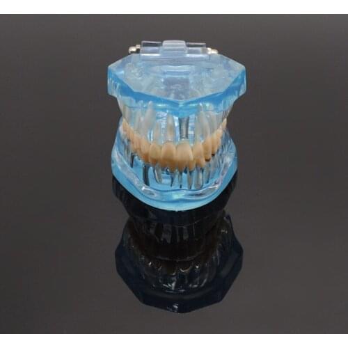 Study Tooth Model Adult Pathological Teaching Teeth Model Caries For Dental Lab
