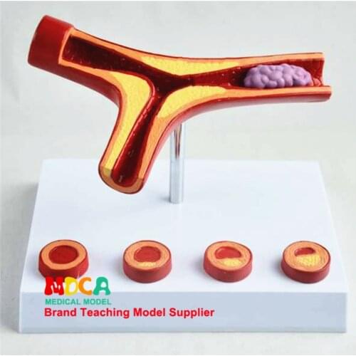 MXG002 Teaching of Anatomical Surface Model Medicine in Arteriosclerosis Model with Thrombotic Coronary Heart Disease
