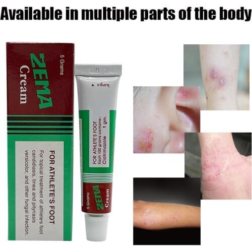 Thai Ointment Chinese Medicine Psoriasis Cream Anti-itch Eczema Mosquito Bites Skin Rash Urticaria Desquamation Treatment