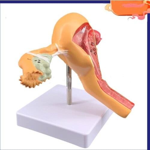 Uterus model, ovarian pathological lesion model, reproductive medicine gift model, female uterus vagina model