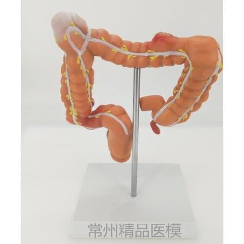 Colon pathological model Colorectal lesions specimens Intestinal anatomy model