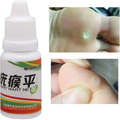 Chinese Medicine Treatment Foot Corn Removal Plantar Warts Pomada De Verruga Foot Care Medical Plaster Ointment Warts Removal