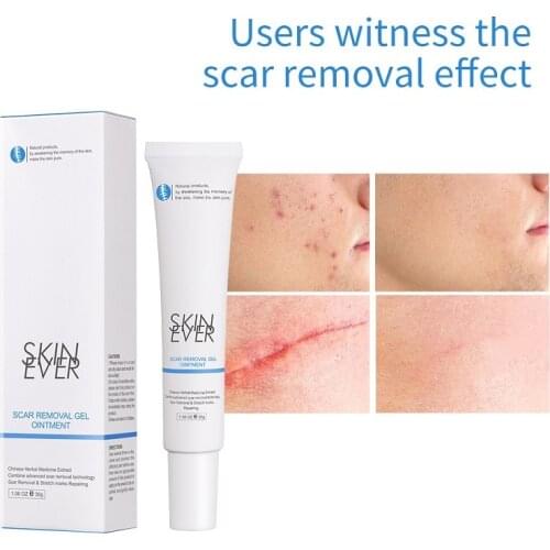 SKIN EVER Herbal Geli Acne Treatment Cream Repair Skin Scar Removal Pimple Mark Remove Scar Gel Fades Scars Face Care TSLM2