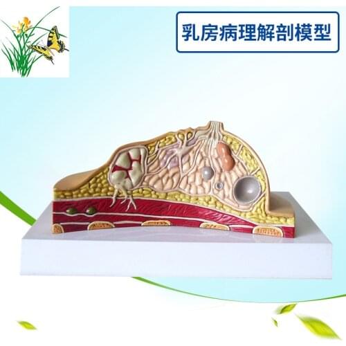 Breast Disease Breast Anatomy Model Human Body Model Anatomical Human Pathological Breast Model Medical Disease & Cancer Anatomy