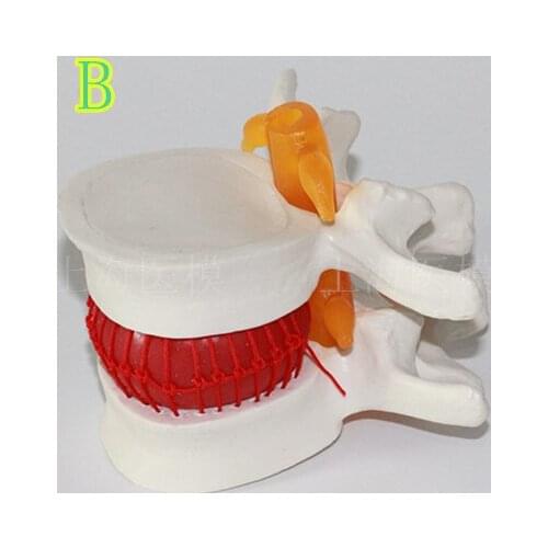Lumbar disc herniation model lumbar vertebrae model vertebral column model