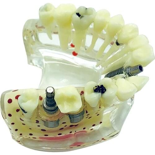 Implant Model Dental Model Teeth Model for Teaching Dentistry Products
