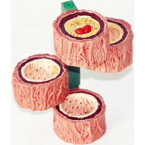 Human vascular atherosclerosis model Thrombus model Vascular model arterial model Thrombosis evolution model