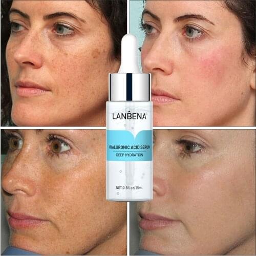 LANBENA NEW Hyaluronic Acid Serum Acne Treatment Skin Whitening Cream Face Anti Winkles Moisturizing HA Essence Beauty