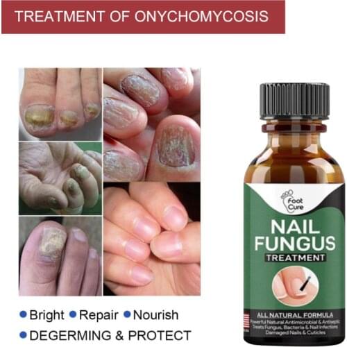 Foot Cute Nail Treatments Liquid Essence Repair Fluid Hand And Foot Onychomycosis Care Antibacterial Thickening Nail Art TSLM2