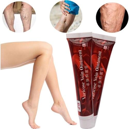 Varicose Veins Treatment Cream Vasculitis Phlebitis Spider Pain Relief Ointment Varicosity Angiitis Removal 100% Original Herbal