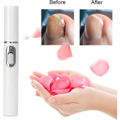 Onychomycosis Laser Pointer Antifungal Nail Pen Painless Nail Care Nail Repair Laser Pointer Effectively Kill Onychomycosis Tool