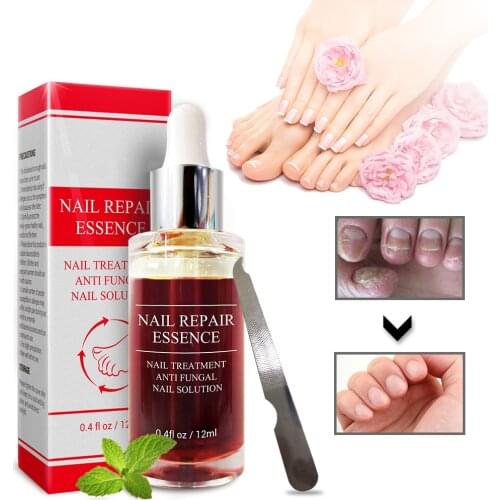 Nail Fungal Treatment Essence Serum Onychomycosis Paronychia Anti-Fungal Nail Infection Toe Fungus Foot Care Nail Repair Tools