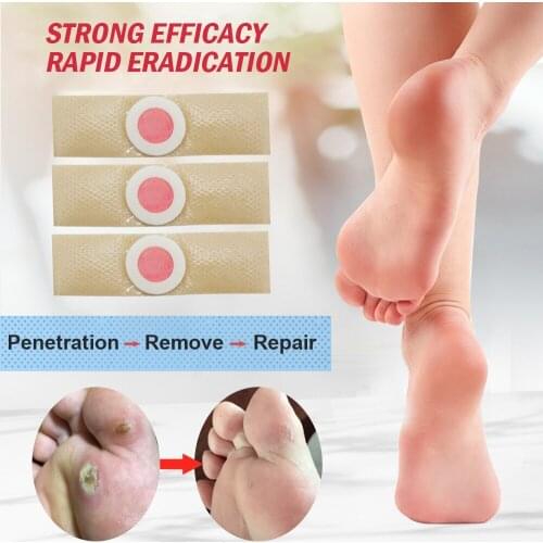 12/30Pcs Detox foot Patch Medical Foot Care Sticker Corn Removal Pads Warts Thorn Curative Patches Calluses Remove Pedicure Tool