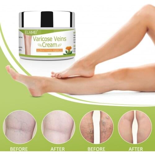 Varicose Vein Cream Treatment Chinese Herbal Medicine Improve Vasculitis Vessel Blood Legs Inflammation Ointment