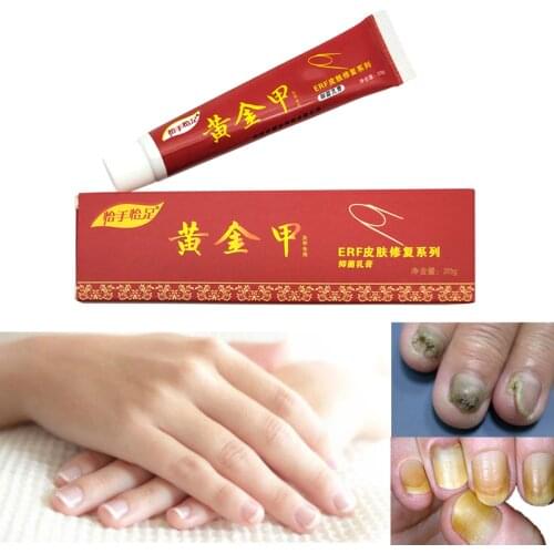 Nail Fungus Treatment / Onychomycosis Paronychia / Anti Fungal Nail Infection Good Result Chinese Herbal Toe Nail Treatment
