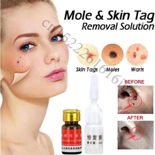 Mole & Skin Tag Removal Solution Painless Mole Skin Dark Spot Removal Face Wart Tag Freckle Removal Cream Oil Plaster