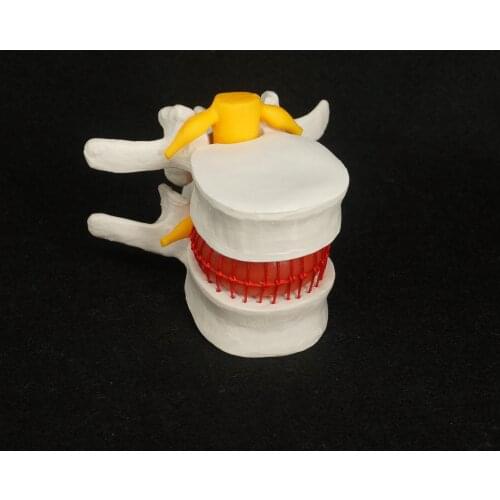 Anatomical Herniated Lumbar Vertebrae Disc Prolapse Model Human Medical Anatomy High Quality PVC