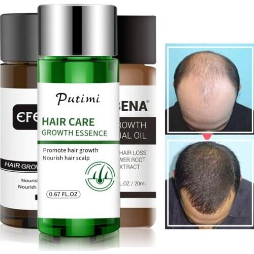 2pcs Fast Powerful Hair Growth Serum Dense Anti Hair Loss Treatment Preventing Baldness Growth Products Hair Care Products