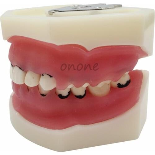 1pcs High Quality Dental Periodontal Disease Model / Tooth Medical Model
