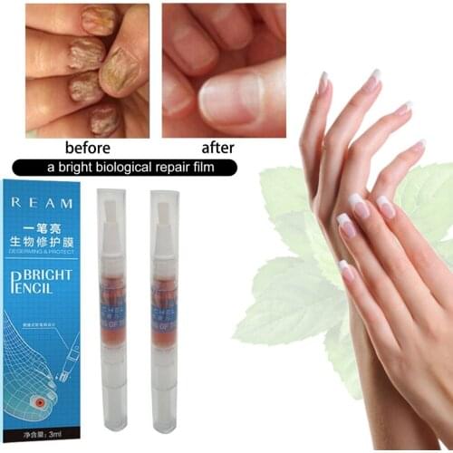 Feet Nail Repair Nutritious Oil Onychomycosis Removal Treatment Liquid Fungus Removal Polish Armor Beauty Pen For Nursing