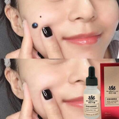 1 Box20ml Dark Spot Removal Face Wart Tag Freckle Removal Cream Oil Mole & Skin Tag Removal Painless Mole Skin