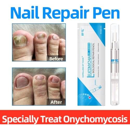1PC Onychomycosis Repair Gel Pen Fungal Nail Remove Chinese Herbal Antibacteria Liquid Onychomycosis Repair Care Solution