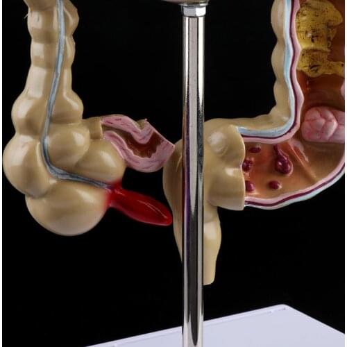 Human Colorectal Lesion Model Pathological Anatomy Colon Diseases Intestine Teaching Learning Tool