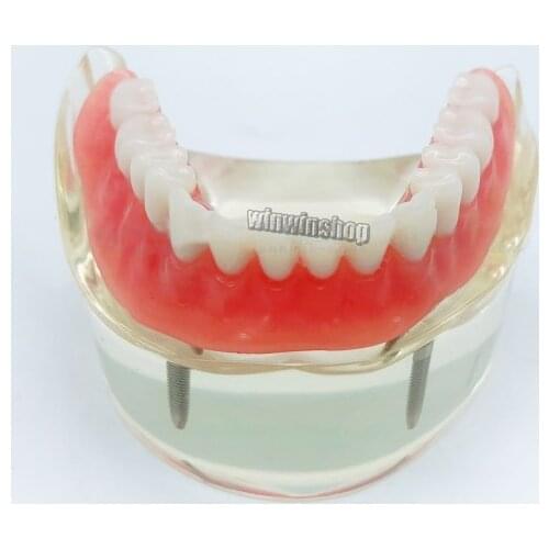 Dental Overdenture Teeth Model Removable Interior Mandibular with 2 Implant for Tooth Teaching Study