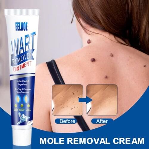 Skin Tags Remover Cream Safe and Gentle Warts Mole Skin Tags Treatment Cream for Men Women Warts Removal