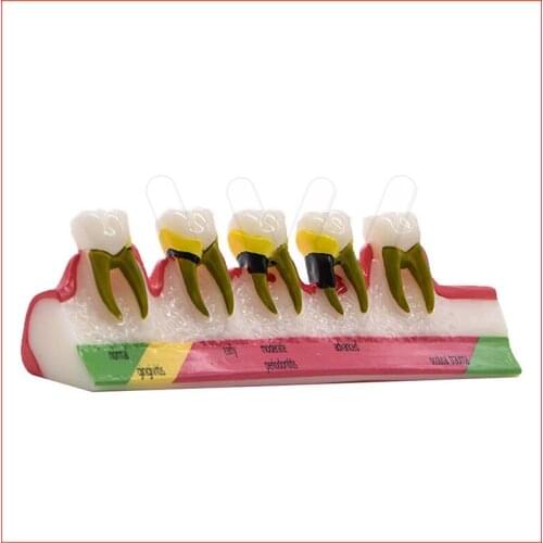 Dental Caries Demonstration Model Teeth Teaching Periodontal Disease Assort Tooth Typodont Model