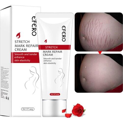 Stretch Mark Repair Cream Remover Removal Scar Body Skin Care for Pregnancy Women SK88