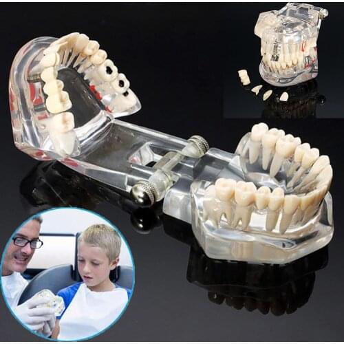 Dental Implant Disease Teeth Model With Restoration Bridge Tooth Model For Dentistry Teaching Tools Dentist Medical Material