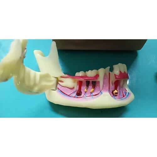 Dental Endodontic Treatment Model Anatomy of gums Dental Study Teach Teeth Model