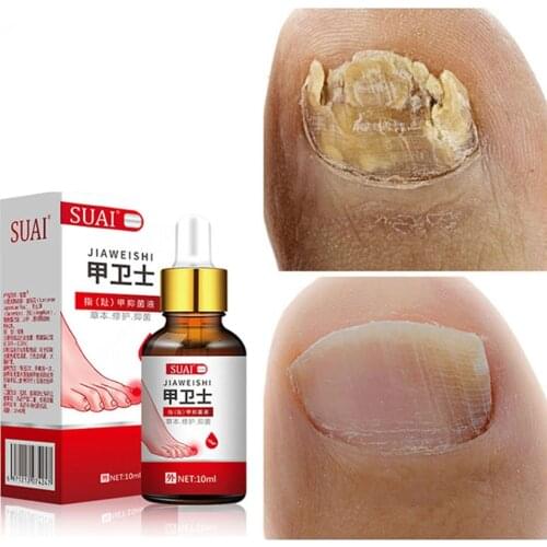 Fungal Treatment Of The Nail Feet Care Nail Essence Foot Whitening Toes Fungus Removal Gel Anti-infection Paronychia Nail Care