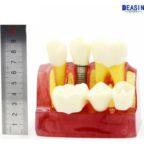 High Quality MACRO IMPLANT MODEL CROWN BRIDGE DEMOSTRATATION TEETH TOOH TYPODONT DENTOFORM