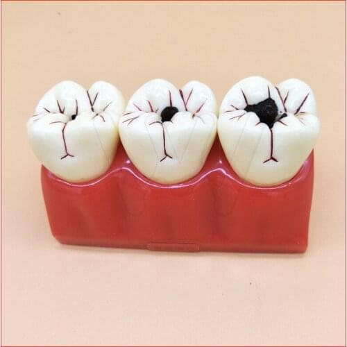 4 times Denture Disease Teeth Model Caries Decomposition Decay Tooth Model For Dental Medical Demo Communication Teaching