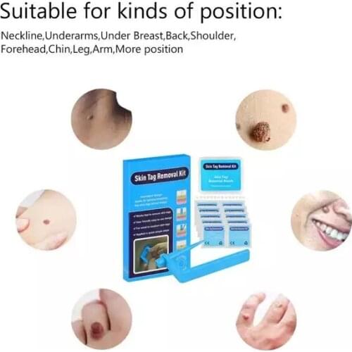 Medical Skin Tag skin tag remover remove Kill mole wart treatment face Skin Tag Removal Tool Acne Remover Cleansing Micro Band