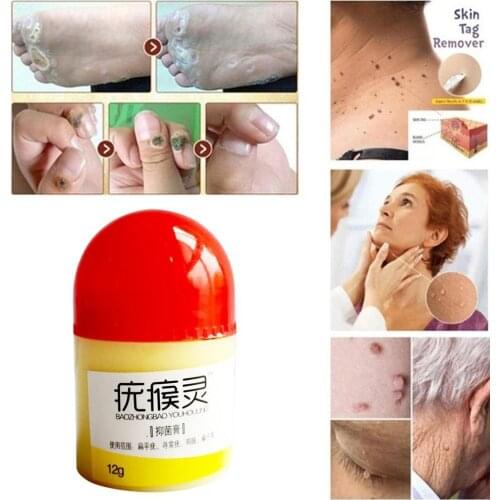 1pc Chinese Traditional Foot Corn Removal Patch Plantar Ointment Care Foot Cream Body Warts Treatment Warts Cream Genital X2J4