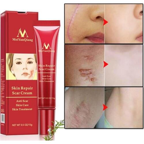 Acne Scar Removal Cream Skin Repair Face Cream Acne Spots Acne Treatment Blackhead Whitening Cream Anti Scar Stretch Marks 15g