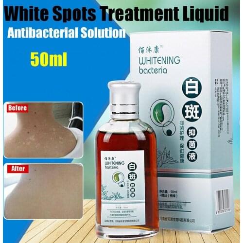 Skin Treatment White Spot Disease Liquid Pigment Melanin Leukoplakia Skin Liniment Treatment Disease 50ml Vitilig Promoting V6X9