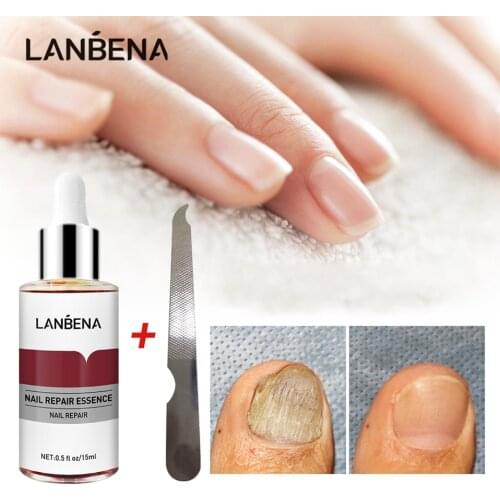 LANBENA Fungal Nail Repair Essence Serum Treatment Onychomycosis Feet Hand Toenail Fungus Removal Anti Paronychia Foot Care New