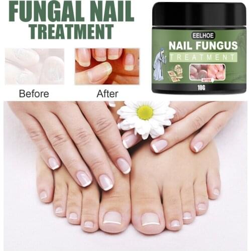 1pcs Nail Fungus Cream Onychomycosis Paronychia Antibacterial Repair Ointment Anti Fungal Feet Toe Care Nail Art & Tools TSLM1
