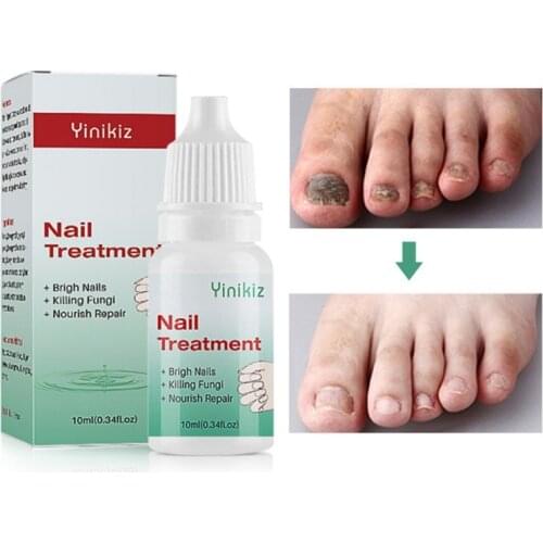 Nail Fungal Treatment Antifungal Onychomycosis Removal Nails Care Repair Liquid Toe Nail Fungus Removal Gel