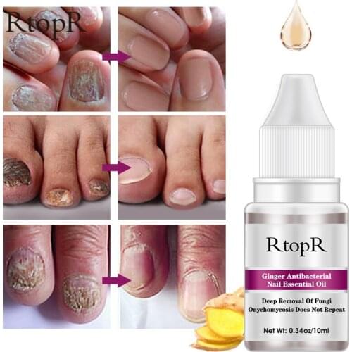 RtopR Fungal Nail Treatment Feet Care Essence Nail Foot Toe Nail Fungus Removal Gel Cuticle Remover Herbal Essence 10ml