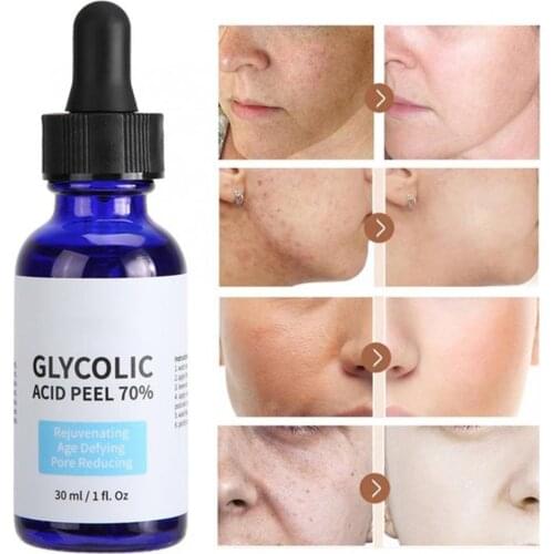 Glycolic Acid Peel 70% Serum Repair Skin Care Shrink 30ml Pores Treatment Serum Moisturizing Face Brighten Acne A6F3
